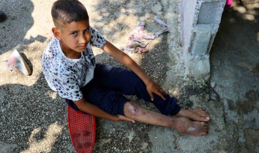 Adana’da ayağındaki kemik yanlış kaynadığı için yürüyemeyen 11 yaşındaki Serdal,