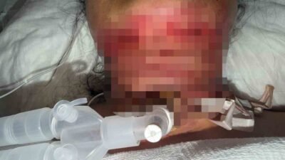Antalya’da gıdı yağlarını aldırmak ve cildini sıkılaştırmak için özel bir