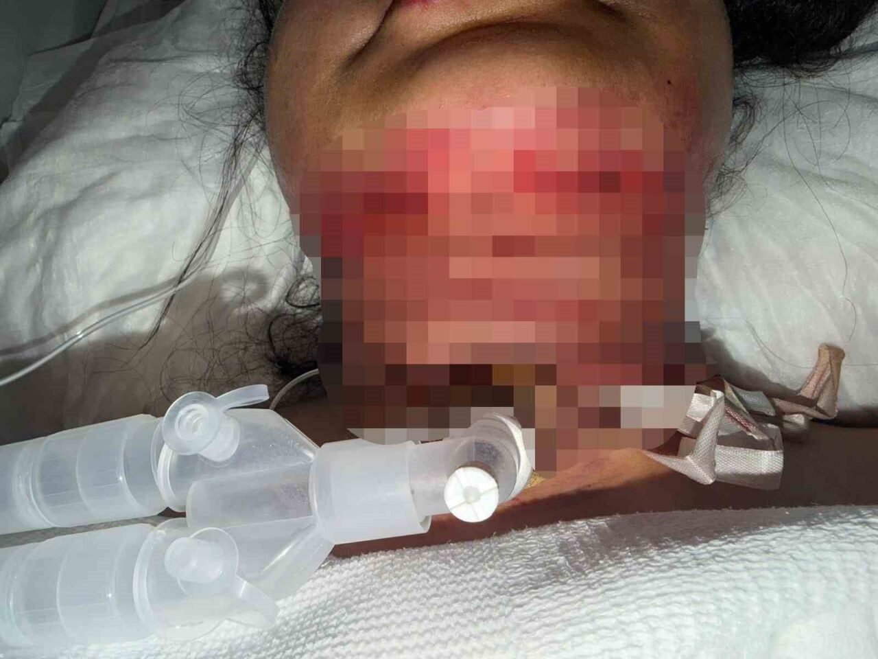 Antalya’da gıdı yağlarını aldırmak ve cildini sıkılaştırmak için özel bir
